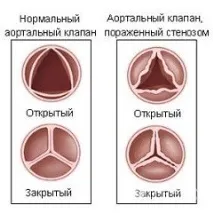 Аортальний стеноз - симптоми, ступеня, лікування лікування