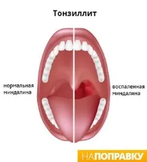 остър симптоми
