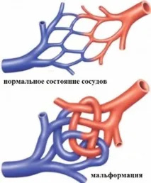 Артеріовенозна мальформація судин головного, спинного мозку, легень, симптоми, лікування, мальформація