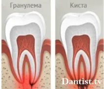 кіста