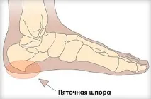 Біль у п’яті під час ходьбипричини, що робити та як лікувати ходьбипричини