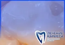 Швидкопоточний карієс – лікування швидкоплинного карієсу лікування