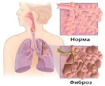 симптоми фиброза