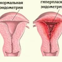 хиперплазия хиперплазия