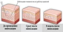 тазобедрената