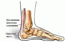 терапия лечение