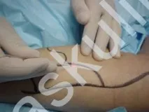 Лікування варикозу лазером що потрібно знати знати