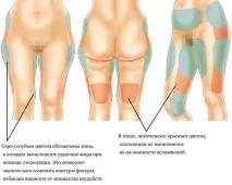 липосукция отзиви