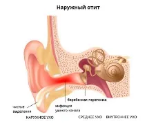 Як проводиться лікування та профілактика зовнішнього отиту проводиться