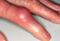 Cum se vindecă artroza degetelor Dr. Vladimir Stepanovici Khoroshev