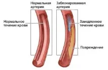 сърцето калцификация