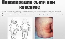 Краснуха у дітей симптоми, лікування, профілактика та харчування лікування