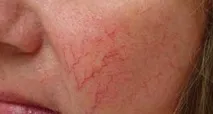 купероза причини