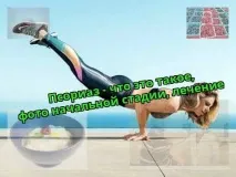 псориазис медицинска