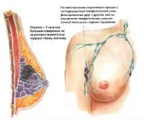 гърдата профилактика