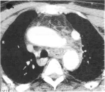 томография hemomediastinum