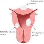 Міома матки та вагітність, Секрети народної медицини. народної