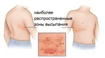 зостер херпес