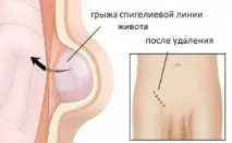 линия отстраняване
