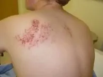 херпес зостер