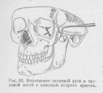 Переломи вилкової дуги, Довідник лікаря переломи