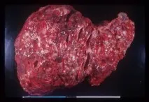 Полікістоз печінки, причини, симптоми, лікування народними засобами, дієта печінки