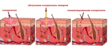 брадавици мъже
