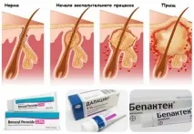 Після гоління інтимної зони з’являються прищі інтимної