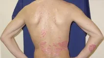 Пува терапія при псоріазі - що це таке, ціни, фото до та після, показання та протипоказання – псоріазі