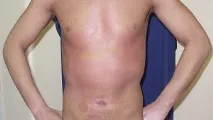 Пува терапія при псоріазі - що це таке, ціни, фото до та після, показання та протипоказання – пува
