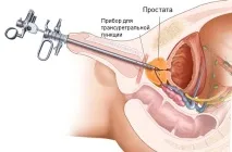 передміхурової