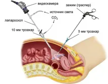 Лапароскопія апендициту показання, можливі ускладнення, період відновлення показання