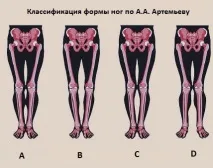 круропластика уголемяване