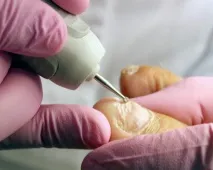 лечение клас