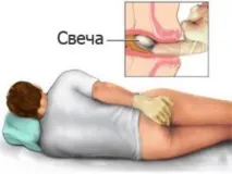 Свічки з анестезином від геморою інструкція застосування застосування