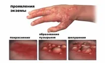 Тавегіл та алкоголь сумісність та наслідки наслідки