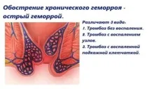 Венарус від геморою склад, дія, протипоказання, як приймати, відгуки склад