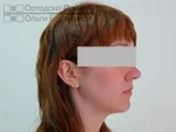 Вирівнювання зубів брекетами під час вагітності - Юлія К зубів