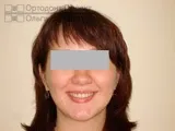 Вирівнювання зубів брекетами під час вагітності - Юлія К вирівнювання