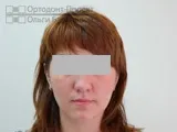 Вирівнювання зубів брекетами під час вагітності - Юлія К зубів