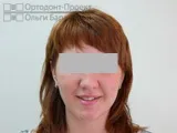 Вирівнювання зубів брекетами під час вагітності - Юлія К вирівнювання