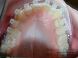 Вирівнювання зубів брекетами під час вагітності - Юлія К зубів