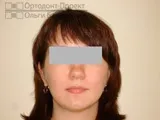 Вирівнювання зубів брекетами під час вагітності - Юлія К брекетами