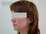 Вирівнювання зубів брекетами під час вагітності - Юлія К вирівнювання
