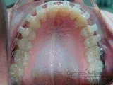 Вирівнювання зубів брекетами під час вагітності - Юлія К вирівнювання