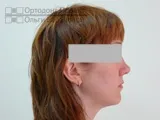 Вирівнювання зубів брекетами під час вагітності - Юлія К брекетами