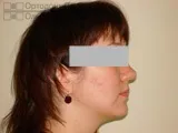 Вирівнювання зубів брекетами під час вагітності - Юлія К вирівнювання