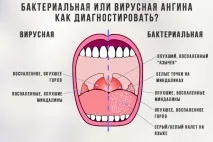 Вірусна ангіна причини, симптоми та лікування захворювання ангіна