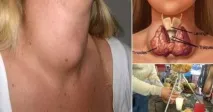 Лікарі ніколи не скажуть вам як вилікувати щитовидну залозу за допомогою тільки одного інгредієнта! вилікувати