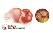 аднексит симптоми